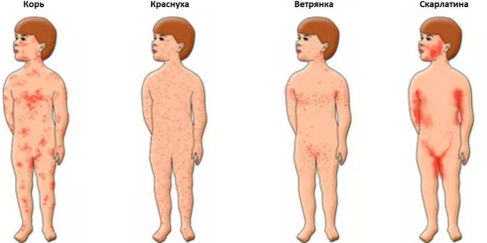 Новости Таджикистана - У ребёнка сыпь по всему телу. Куда бежать – к  аллергологу, педиатру или кожнику?
